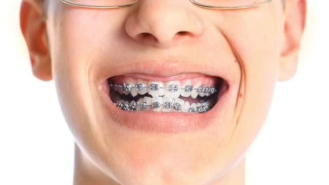 Dental Braces Your Guide to a Straight Smile