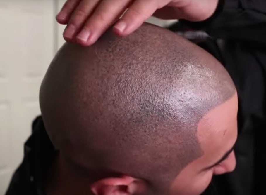 Scalp Micropigmentation for a Sharp Hairline